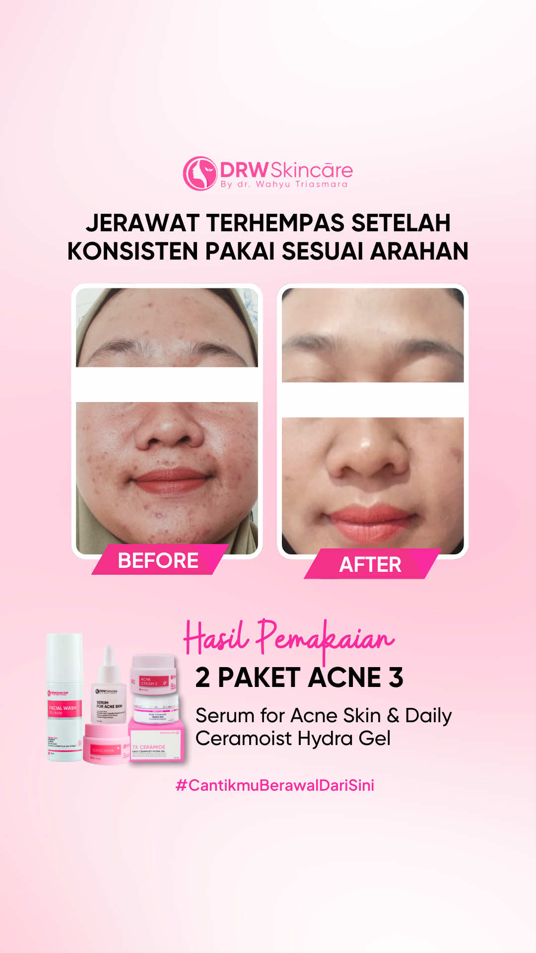 Kuncinya bukan instan, tapi tepat sesuai arahan! Setelah habis 2 paket Acne 3, bopeng dan jerawat jadi mereda~ Ingin dapatkan produk dan penanganan yang tepat?  Konsultasi sekarang lewat DM atau komen, ya! #testimonidrwskincare #beforeafter #bopeng #drwskincare #testimonidrw 