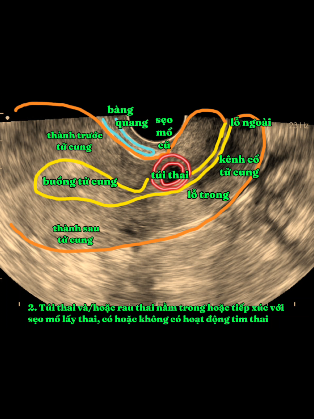 Các dấu hiệu chẩn đoán th.ai bám sẹo mổ cũ trên siêu âm: 1.  2.  3.  4.  5. #sieuam5d #molaythai #bshuynam #sieuambsnam 