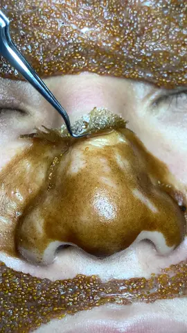 Ngon #chamsocdamun#chamsocdaseo#chamsocdanam#tanbinh#Lqspa&academy