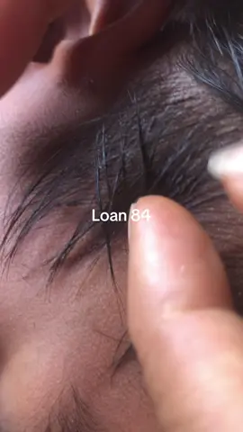 lice removal #omg😱😱 #😱😱😱 #lice #trending 