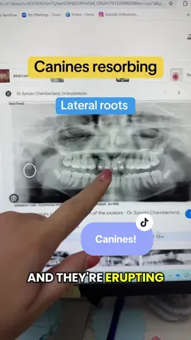 Going to the orthodontist at age 7 ensures that your child is getting the best care!  MOST of the time nothing needs to be done. The main things we would need to intervene for would be a crossbite or eruption of the permanent teeth are compromised!  These things are harder to fix later on once all the permanent teeth are in or may have already caused harm!  #braces #expander #crossbite 