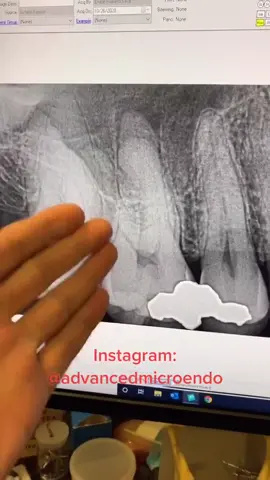 Almost always an mb2. #dentists #dentalstudent #dentalhygienist #rootcanal #dentalofficelife 