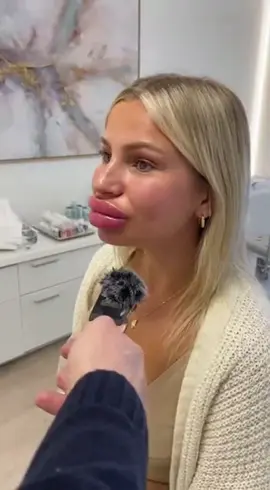 Es wirkt einfach total natürlich 🤣 #botox #lippenaufspritzung #schönheitsop #viral #fyp 