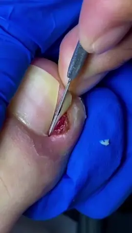 💖 Cuidar é transformar dor em bem-estar. Acompanhe cada detalhe desses momentos de alívio 👣 #tiktokbrasil #unhasperfeitas #pedicure #antesedepois #unhas 