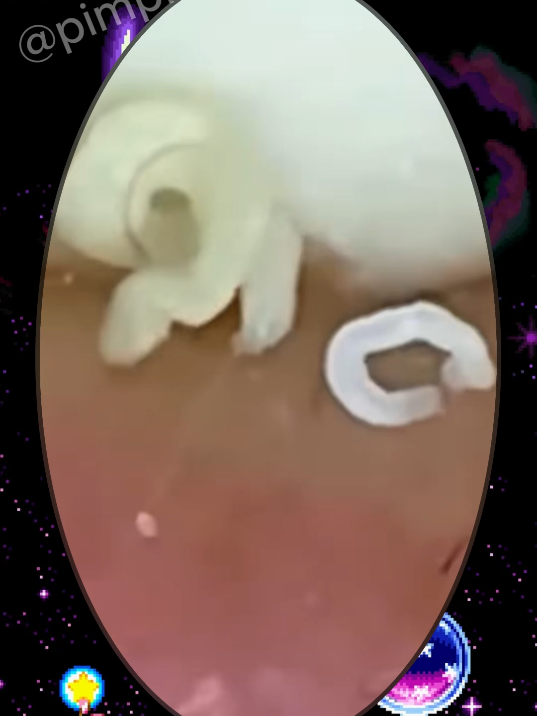 Pimple Of Today #723 #blackheads #acne #shorts #whitehead #blackheadremoval #pimple #blackheadspopping #fyp #relaxingvideos #relax #satifying