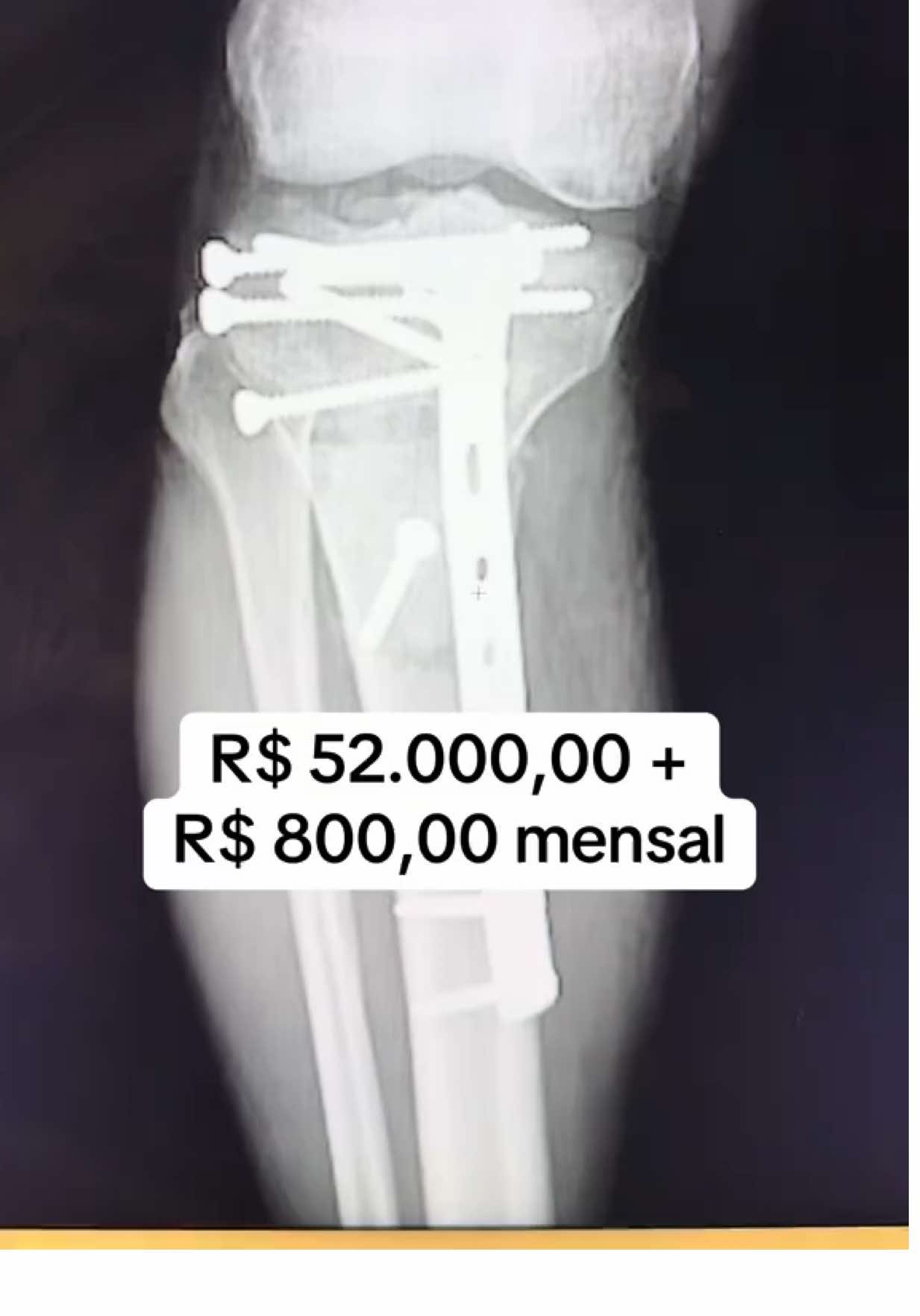 Quem tem placa ou parafusos no corpo pode ter direito a uma indenização mensal do INSS! ⚖️ #inss #acidente #advcarolinafreitas #indenização #aposentadoria 