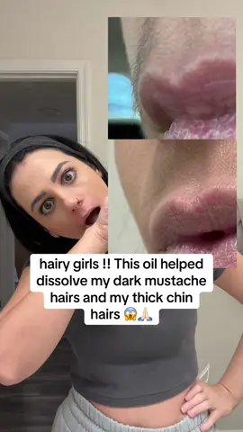 I wish I knew about this oil sooner before wasting all this time shaving and waxing!!! #cyperusrotundusoil #facialhairremoval #pcos #facialhair #hairremovaloil 