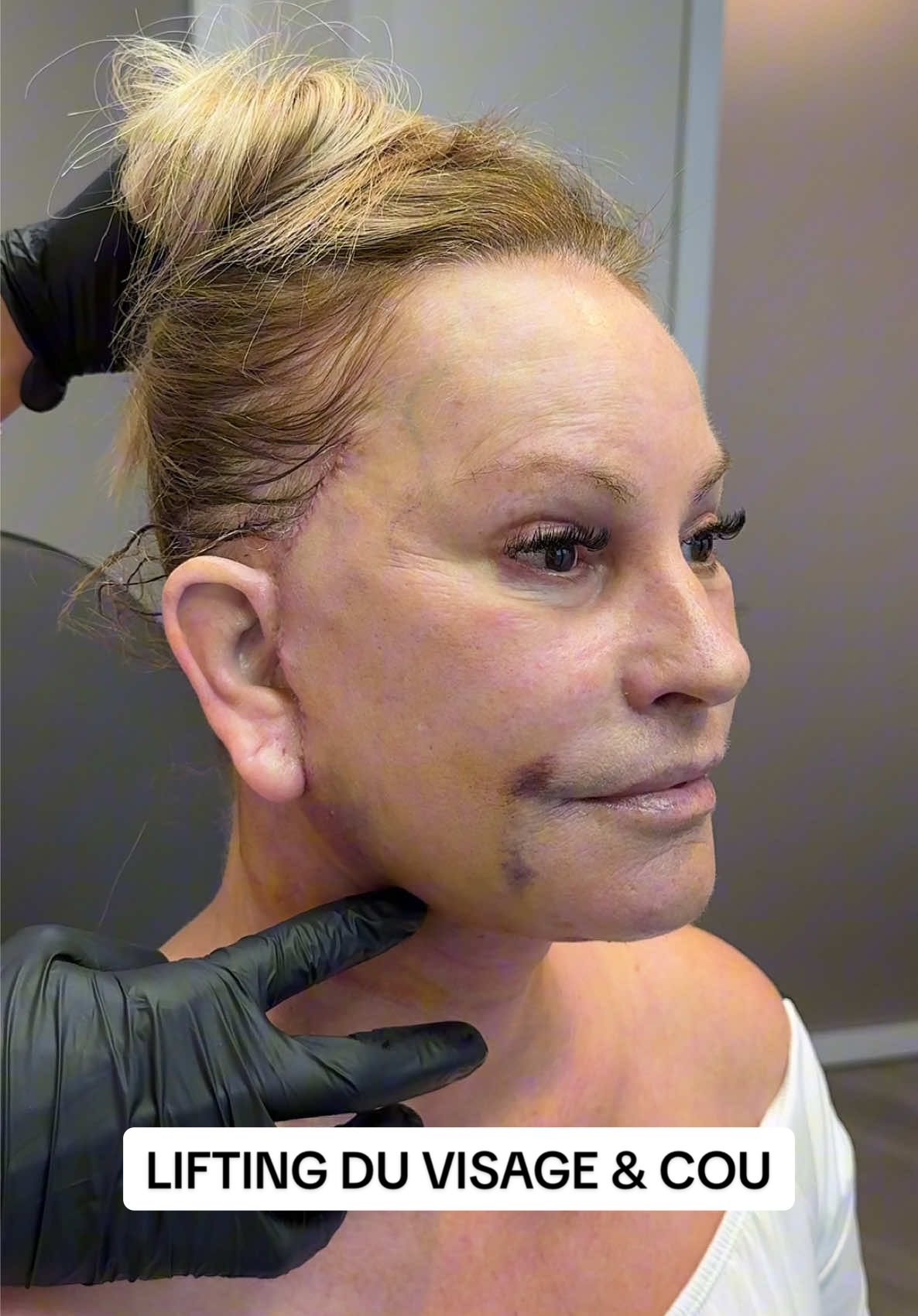 ✨ Un 2e Lifting, une nouvelle expérience ✨ C'est avec une immense gratitude que nous partageons le témoignage de cette patiente exceptionnelle. Elle a eu un premier lifting il y a 11 ans (avec un autre chirurgien), qu'elle a trouvé extrêmement difficile. Aujourd'hui, seulement une semaine après son lifting du visage et du cou des plans profonds, c'est une tout autre histoire! Son soulagement et son sourire en disent long. C'est cette différence qui est notre plus grande fierté. Merci infiniment pour votre confiance et votre générosité. 🙏😊 We can't wait to show you the results once she is fully healed! Photos & videos published with informed written consent of the patient. Not a guarantee of results. Educational purposes only. Source: Dr. Moubayed’s practice. #deepplanefacelift #facelift #necklift #lifting #quebec    