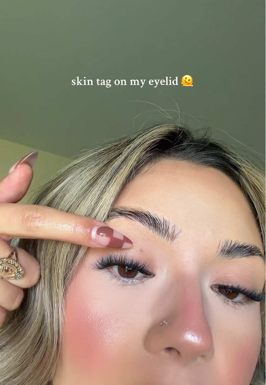 skin tag on my eyelid 🫠 what the helly… #skintags #skincondition #helpme #dermatologist #skindoctor 