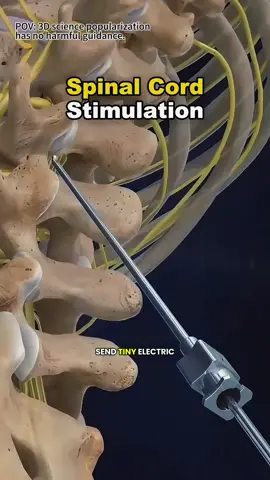 Spinal Cord Stimulator (SCS) Implantation Procedure (3D Animation) #spinal #cord #procedure #SpinalCordStimulator #ChronicPainRelief #MedicalTikTok #TikTokDoctor #SCSImplant #BackPainTreatment #NervePainRelief #PainManagement