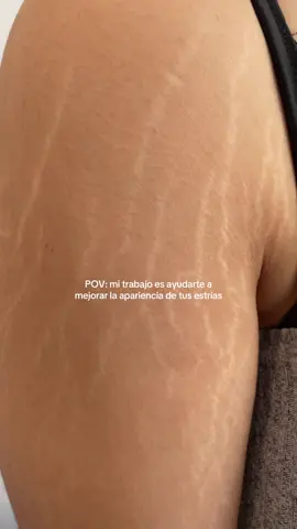 Comenta “Dorian” si tienes estrías y agenda una cita en el enlace de mi perfil 🪄  #estrias #regeneracioncelular #dorianskin #cdmx 