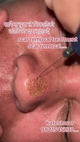 #scar #removal #pigmentation #daag #fyppppppppppppppppppppppp 