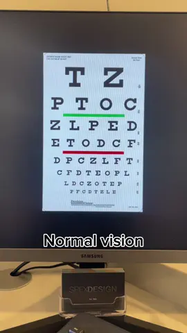 Ever wondered how people with poor eyesight see the world? 👀 Here’s what vision looks like from 0 to -5 diopters — no glasses, no contacts! #spexdesignoptometrist #optometry #eyes #prescriptionglassses #foryoupage 