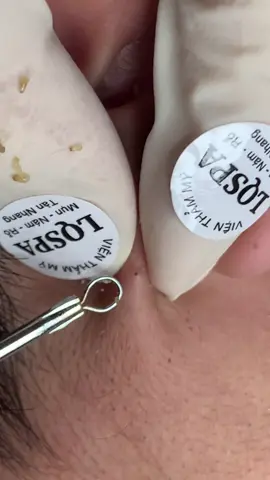 Thèm#chamsocdamun#chamsocdaseo#chamsocdanam#tanbinh#Lqspa&academy