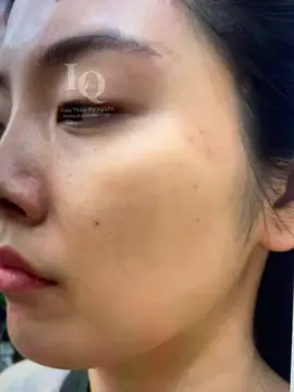 Cập nhật da nám #chamsocdamun#chamsocdaseo#chamsocdanam#tanbinh#Lqspa&academy