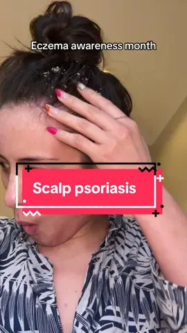 That feeling of GUILT after a scratch attack especially after #itching your #dryscalp & creating a #dandruff blizzard with chunks all stuck in your hair 😩 #scalppsoriasis #eczemaawarenessmonth 