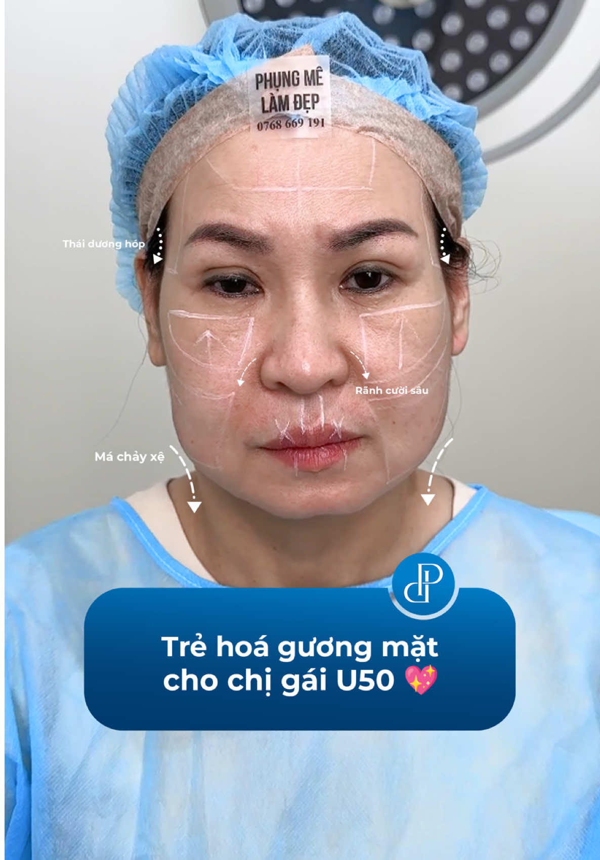 T.r.ẻ h.ó.a gương mặt cho chị gái U50 🥰 #phungpremium #phungmelamdep #canchinhguongmat #aminoplus #vuthiphung 