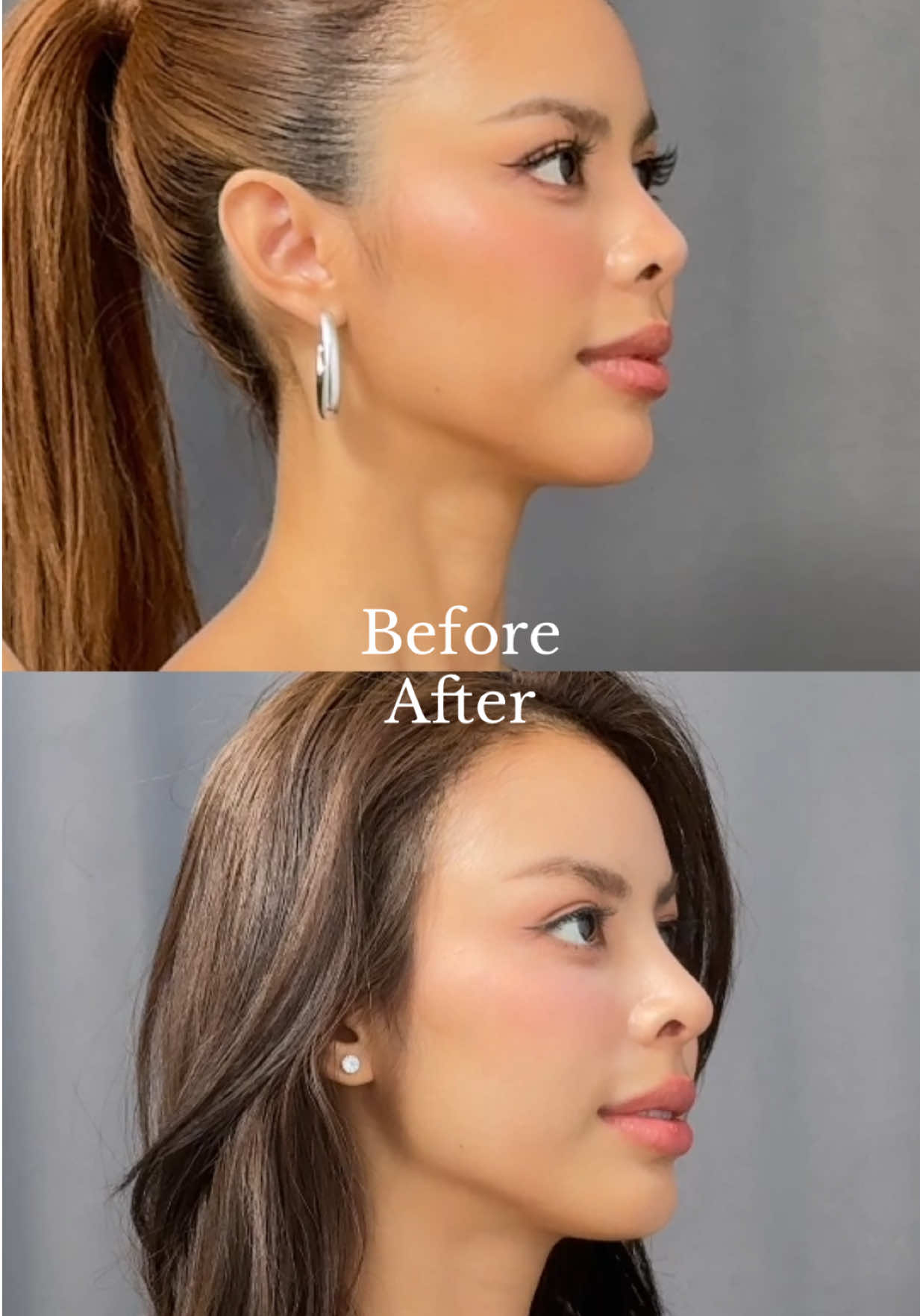 มหากาพย์การทำจมูกที่คนถามเยอะมากว่าบวมมั้ย ดูคลิปนี้เลยค่ะ 🥹🫶🏼🙏🏻@thekliniquesurgery #ศัลยกรรมจมูก #theklinique #น้ําเพชรอิสรีย์ #น้ําเพชรดาราสาว #nxmpez 