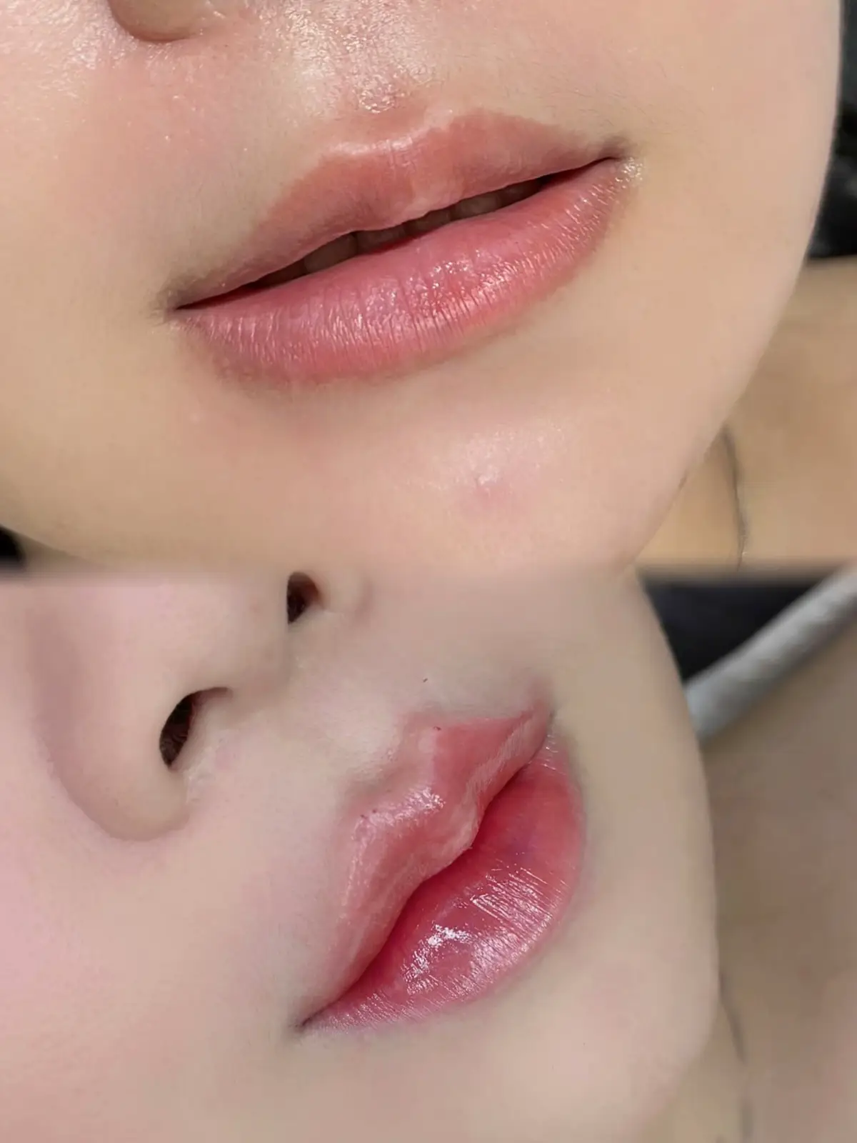 #homaihuongfiller #tiemmoifiller #douyin抖音 #moibabythietke 