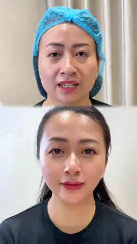 cân chỉnh cho chị khách u40 về u20 #fillerbotox #solbeauty #goclamdep #filler #bacsitrangha 