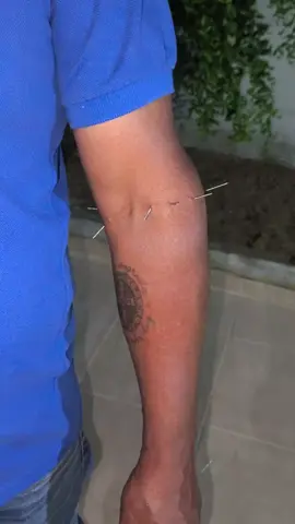 Muitos anos com dores crônicas no joelho e lombar, olha só o poder da acupuntura em 1 só sessão. é imediato!!!  #acupuntura  #dorcronica 