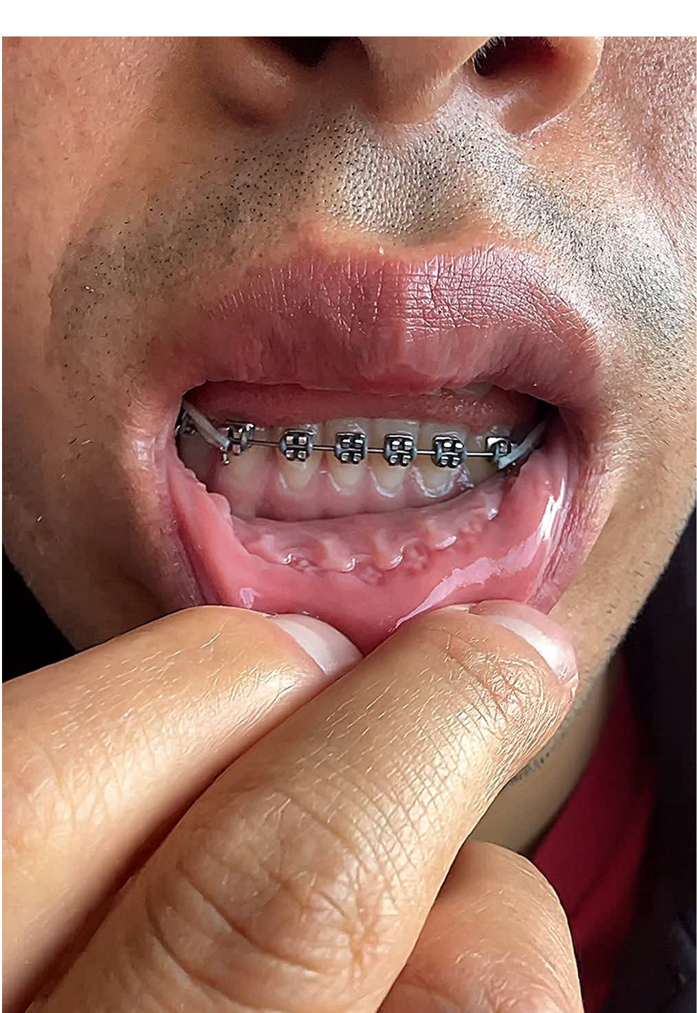 Ayuden #ortodoncia #brackets #ligas #brace #brack 