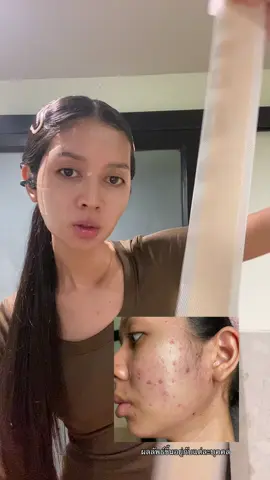 แปะละไปนอนคือดีย์ #ส้มโอที่หน้าเป็นสิว #แผ่นแปะซิลิโคน #แผ่นแปะซิลิโคนเจล #แผ่นแปะซิลิโคนลบรอยแผลเป็นbebetter #แผ่นแปะซิลิโคนลดรอยแผลเป็นbebetter 
