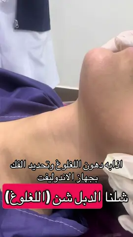 اذابه دهون اللغلوغ في جلسه #للحجز والاستفسار 0508963022 #المملكه_العربيه_السعوديه🇸🇦 #الشعب_الصيني_ماله_حل😂😂 #الاستشاري_محمد_الجديبي #مجمع_توهج_الطبي #pyf #الدبل_تشن #لغلوغ #لغلوغي #لغلوغ #اذابه_اللغلوغ #تحديد_الفك 