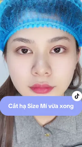 Cắt hạ size mí vừa xong . Mời mn vào ngắm nhé #sửamílỗihỏng #cắtmí #cắt_mí_tự_nhiên #bắcninh #kcnvsipbắcninh 