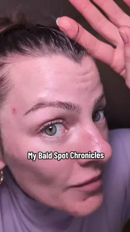 minoxidil for women and it WORKS even if u miss it for a week #minoxidil #baldspot #hairloss #hairthinning #hairhealth 