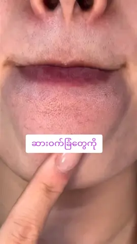 ဆားဝက်ခြံတွေတစ်ပတ်အတွင်းပျောက်ချင်မှသုံး✅မပျောက်ချင်ရင်မသုံးနဲ့❌#ဝက်ခြံပျောက်ချင်သူများ #TEပျားမျက်နှာသစ် #အိမ်ရောက်ငွေချေမှာယူနိုင်ပါတယ်ရှင့် #အနှင်း 