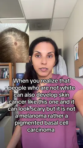 Where my fellow brown skin friends? We too can get skin cancer #basalcellcarcinoma #skincancer #fyp 