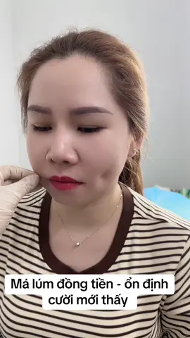 Tạo má lúm #málumdongdieu #taomalumdongtien #chuyenmalumdongdieu 