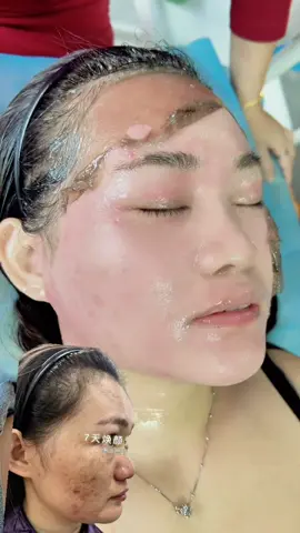 [福]7天膜祛斑，是祛斑抗衰一体，祛斑的同时可以达到提升，松弛，下垂，效果，包括眼细纹，抬头纹，川子纹，面部凹陷都可以一次解决，咱们主要是百分之80技术➕百分之20膜➕修复 7天揭完膜后皮肤下毒素，痘痘、激素，任何斑点、小皱纹、黑头、黄气、暗沉，全吸取于膜上带岀来，就相当于给皮肤做了一次系统还原达到干净美白皮肤。男女通用！#viral #views #fyp #上热搜热门 