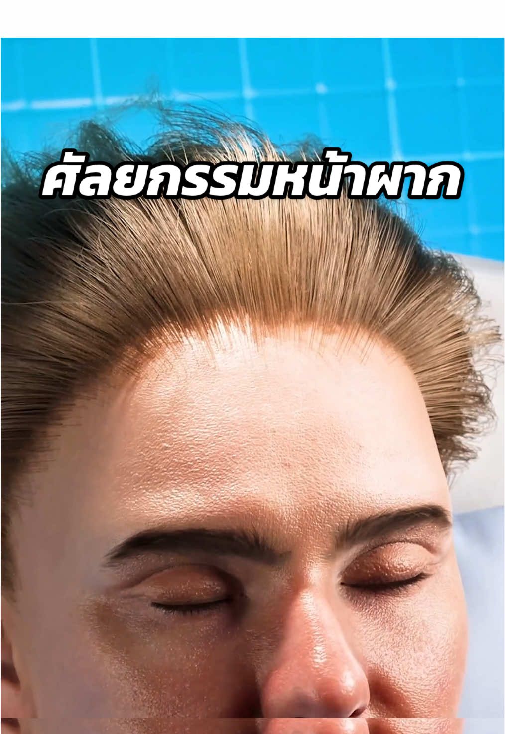 ศัลยกรรมหน้าผาก😱 #สาระความรู้ #ความรู้รอบตัว #เรื่องจริง #เรื่องเล่า #ฟีดดดシ Cr. Zack D Flims