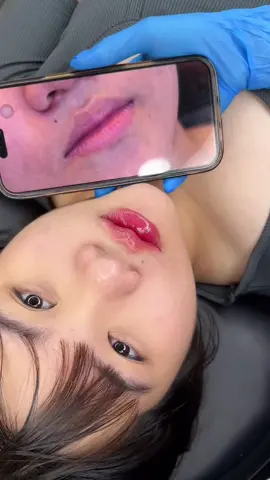 Môi xinh cho khách iu 💉💉#Fillerbotox #môi_ #viral #ibox_sớm_để_đặt_lịch_tiêm_tại_nhà 