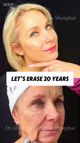 Die Zeit vergeht – aber dein Ausdruck muss es nicht. Kleine Schnitte, große Wirkung. Mein Facelift gibt dir zurück, was die Jahre genommen haben. Wenn du könntest – würdest du die Zeit anhalten? #tiktok #facelift #beauty #ästhetik #hautpflege #antiaging #selbstbewusstsein #jugendlichesaussehen #mindset 