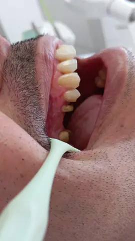 bridge en zircone 🦷 #قبل_وبعد #explore #zirconia #fypシ゚ #dentist 