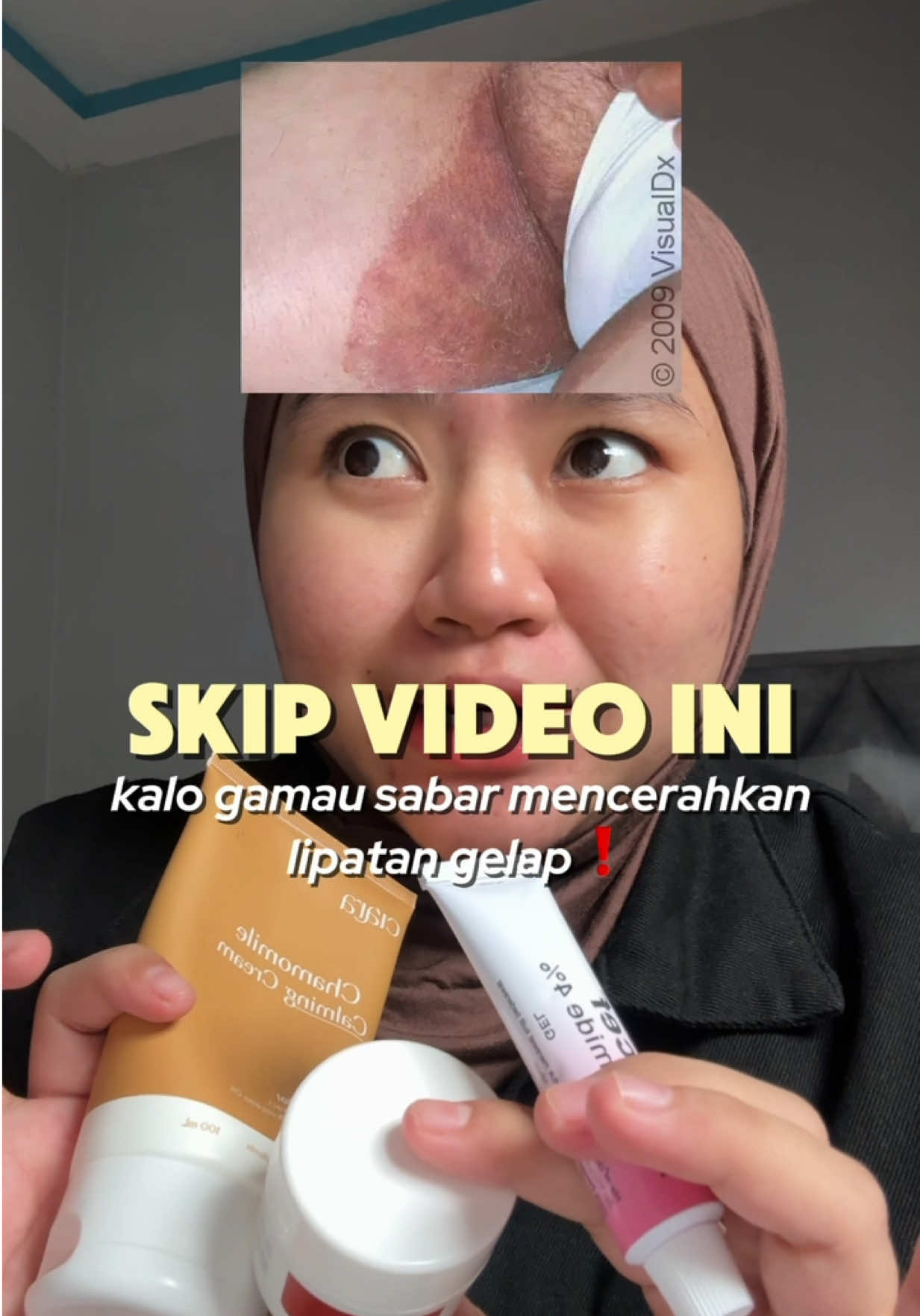 buat yang sabar sabar ajaaa😭🙏🏻 #slengkihitam #tineacruris #jamurkulit 