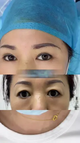 提眉即刻对比 #无痕提眉 #面部紧致 #面部年轻化