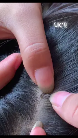 😱😱😱#omg #lice #liceremoval 