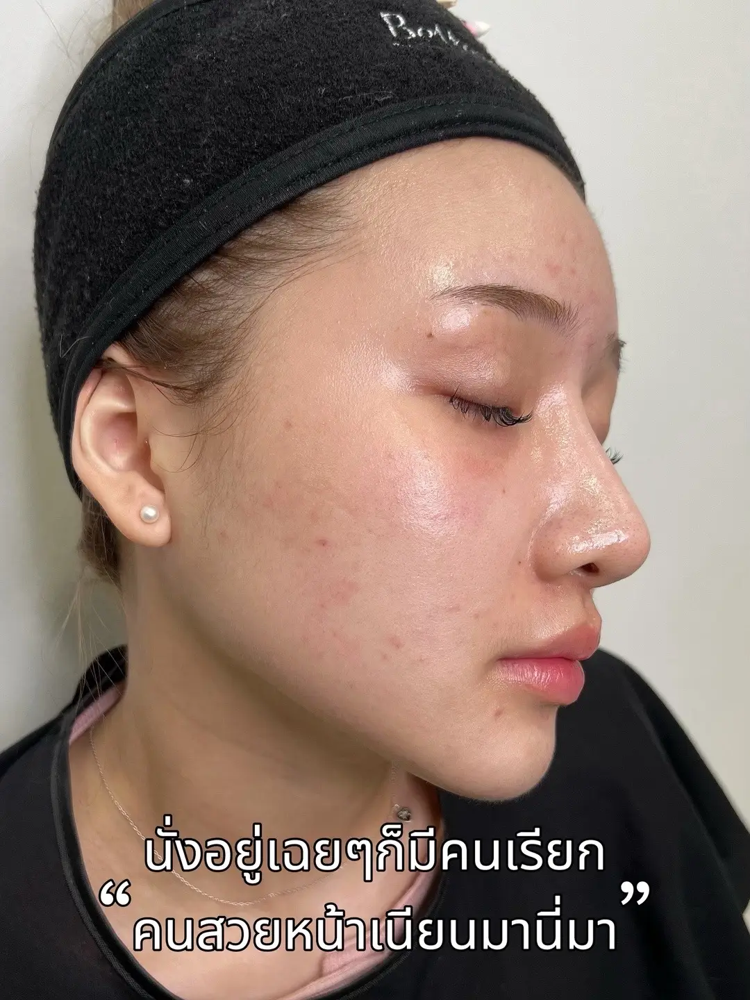 คือมันจึ้ง มันเลิศ หน้าเนียนมากกผิวแบบ Glass skin สุดๆ🥰💖 #bettermeclinic #fractionalco2laser #รีวิวบิวตี้ #หน้าเนียนใส  #glassskin 