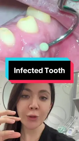 #duet with @Dr. Hassan Aurag #abscess  Infected tooth by dentist Melbourne 