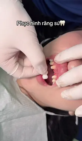 Phục hình răng sứ-tìm lại nụ cười #tiktok #veneer #rangsuthammy #viral #fyp 