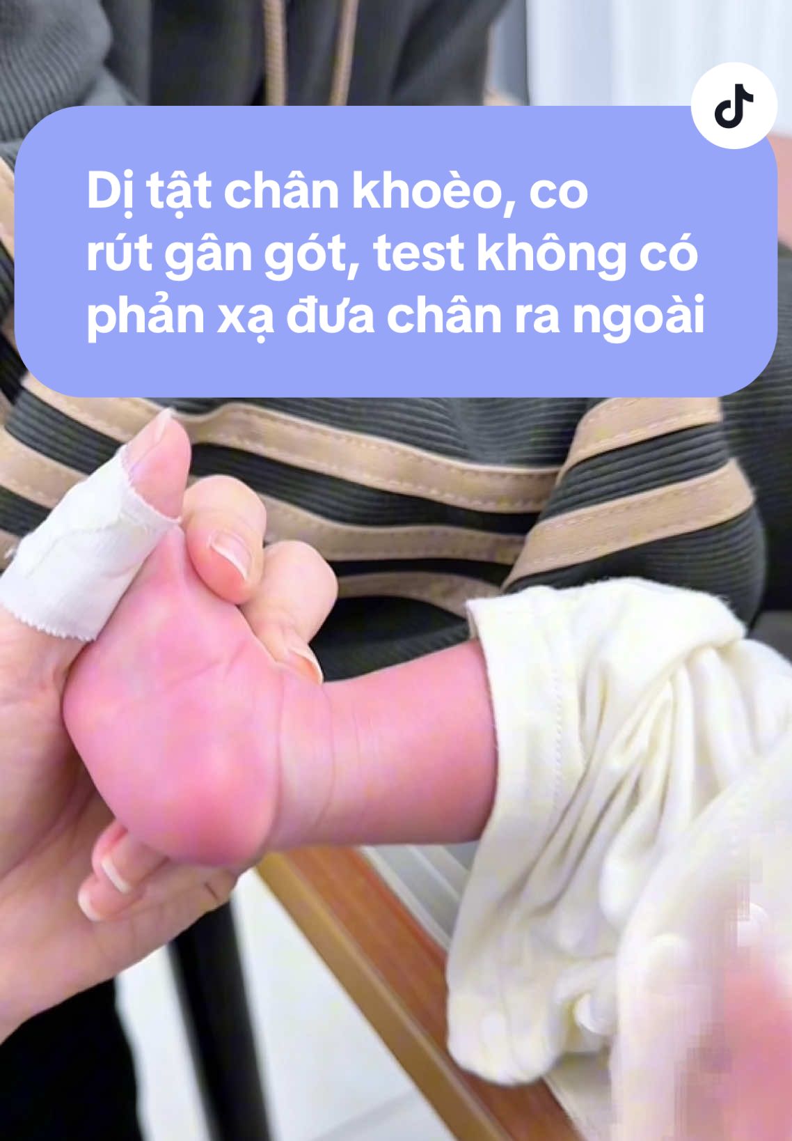 Con bị dị tật chân khoèo bẩm sinh, đã được bó bột 2 lần. Con tới PK vẫn còn tình trạng co rút gân gót, test vận động không có phản xạ đưa chân ra ngoài. Bame lựa chọn phương pháp băng nẹp tại PK cho con để nhẹ nhàng hơn, 2 ngày con sẽ được băng lại 1 lần. Bé yêu cố lên nhé con ơi, vì một tương lai có đôi chân bình thường để chạy nhảy chơi đùa nè ❤️ #vltl #phcn #vltlthanhthuy #ditatbanchan #chankhoeobamsinh 