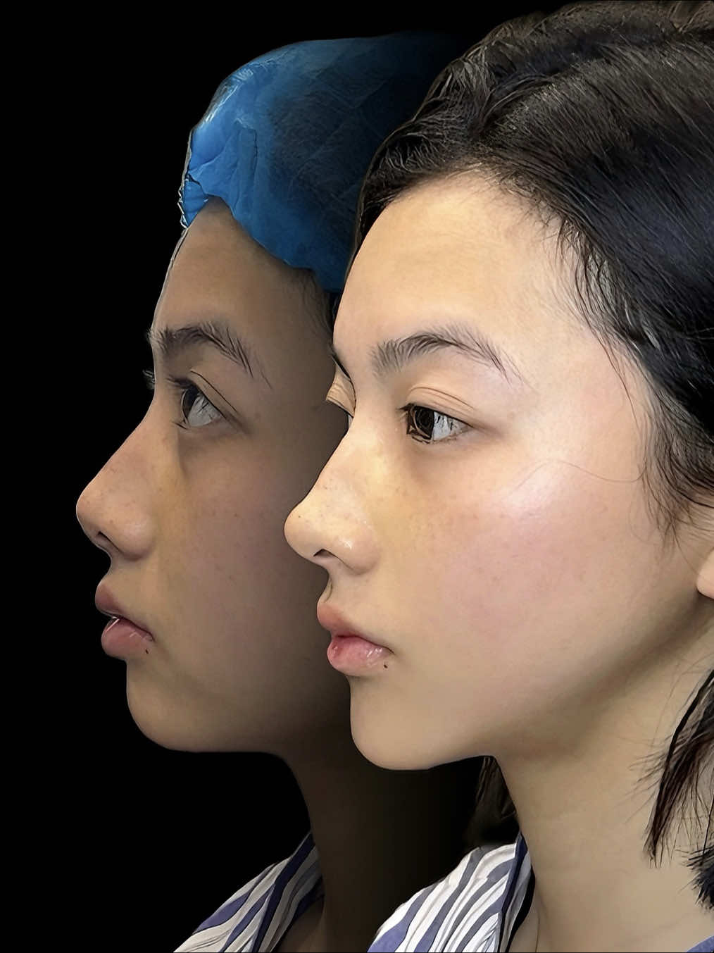 The nose can change the entire face—it's every girl's dream nose. #nosejob #코성형 #asianrhinoplasty #Rhinoplasty #nose 