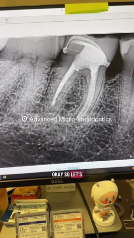 Don’t over treat. #dentists #dentalstudent #dentalhygienist #rootcanal #dentalofficelife 