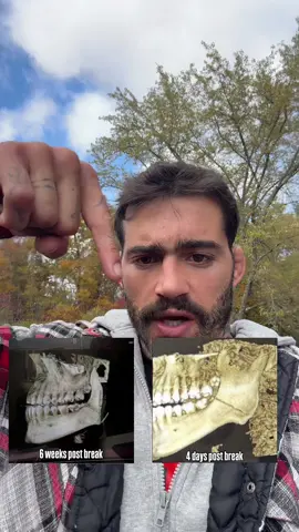 Healing like Wolverine or whatever #brokenjaw #muaythai #injury 