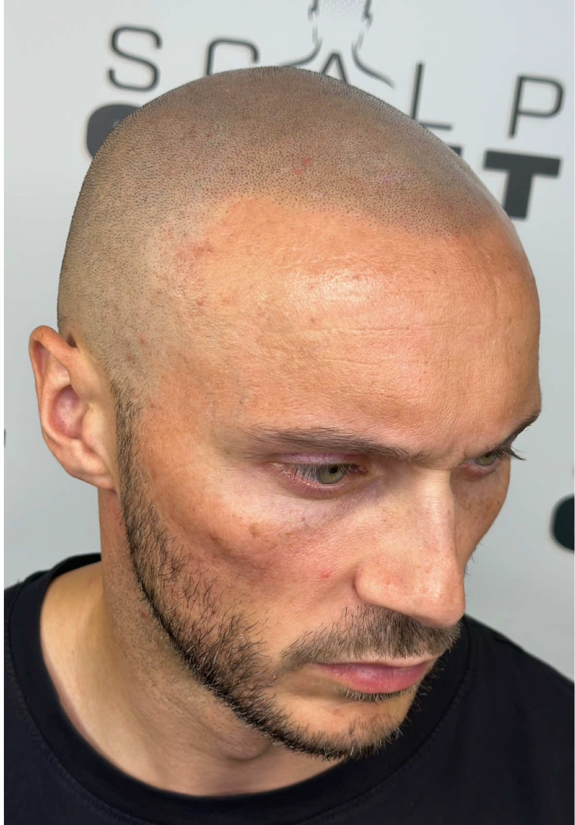 …𝗿𝗲𝗰𝗲𝗱𝗶𝗻𝗴 𝗵𝗮𝗶𝗿𝗹𝗶𝗻𝗲? 𝗞𝗲𝗲𝗽 𝗿𝗲𝗮𝗱𝗶𝗻𝗴… At Scalpcraft, we create natural-looking hairlines and the appearance of a full, shaved head using Scalp Micropigmentation (SMP)—a subtle yet powerful solution that restores confidence and gives a general feel good factor.  This innovative technique creates the illusion of cropped hair using a micro needle and pigment to replicate hair follicles on the scalp.  This procedure is perfect for those who are experiencing hair loss or thinning hair, as it can help you regain your confidence and feel more comfortable in your own skin. Our consultations with Chris are relaxed, informed and better still, completely free. Interested in learning more? Simply drop us a message or email with your contact details and we’ll get back to you.  𝗦𝗖𝗔𝗟𝗣𝗖𝗥𝗔𝗙𝗧® SMP by Chris Blake Award winning SMP artist  Rising Star Europe 🏆 ★ ★ ★ ★ ★ Trusted Google Reviews  SUBTLE • NATURAL • CRAFTED ☎️ 07300 845 866 🖥️ www.scalpcraft.co.uk 📧 chris@scalpcraft.co.uk #scalpmicropigmentation #SMP  #HairLoss #hairTattoo    