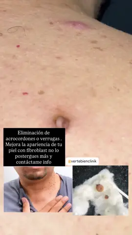 📍Pereira centro 6ta local  Servicio de Cosmetologia y tratamientos rejuvenecedores  Elimina los acrocordones o verrugas  desde la primera sesión agenda tu turno 